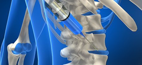 척추 디스크에 주사 시술